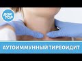 Врач-эндокринолог объяснила, что такое аутоиммунный тиреоидит