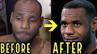Celebrities and Hair loss
