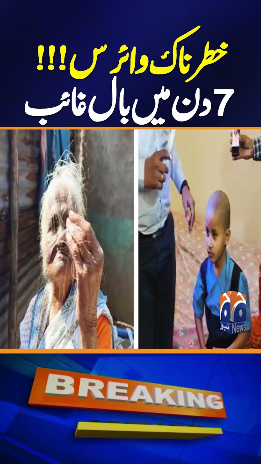 7-Day Hair Loss: Dangerous Virus Warning !!! | Must Watch | Geo News
