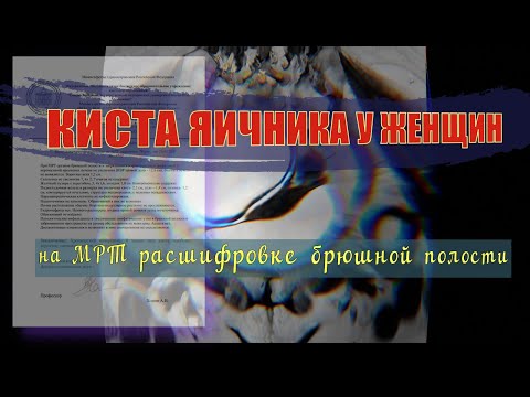 Параовариальная КИСТА ЯИЧНИКА у женщин и хронический ПАНКРЕАТИТ на РАСШИФРОВКЕ МРТ брюшной полости