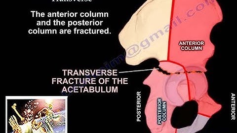 Acetabular Fracture Transverse Fracture - Everything You Need To Know - Dr. Nabil Ebraheim