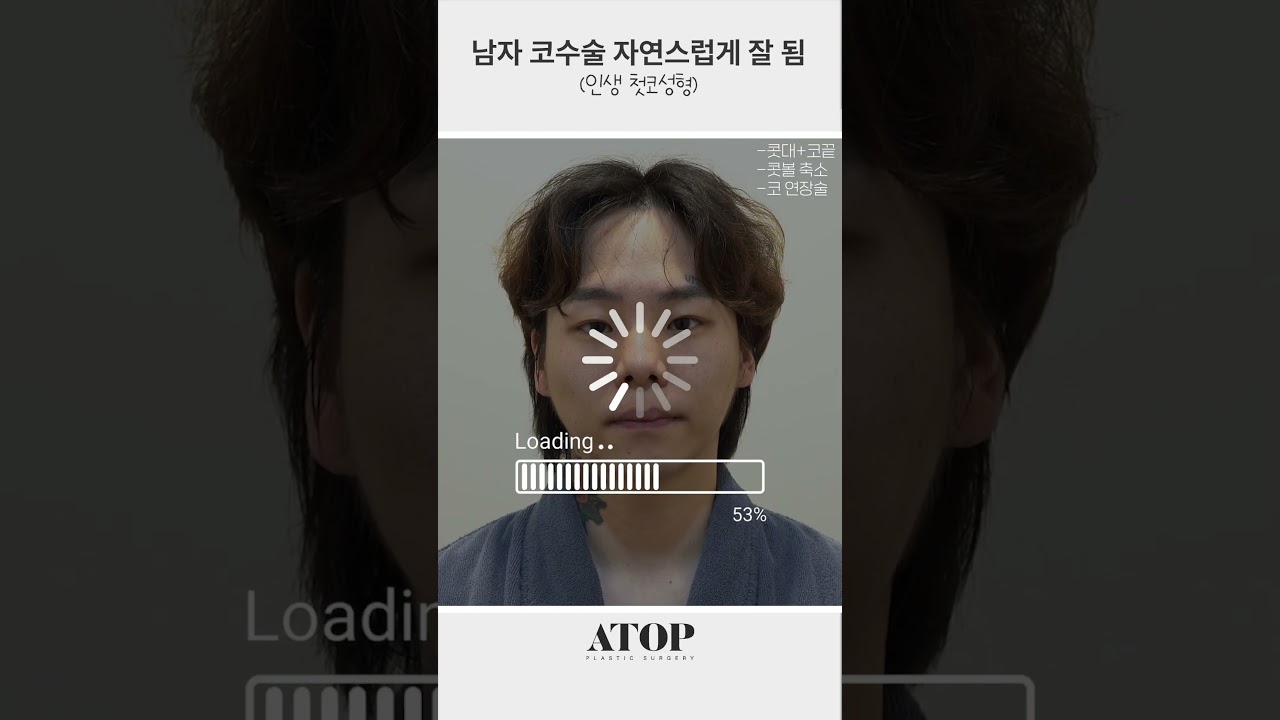 [醫拓整形外科] 男性隆鼻手術效果自然良好 (人生第一次鼻部整形)