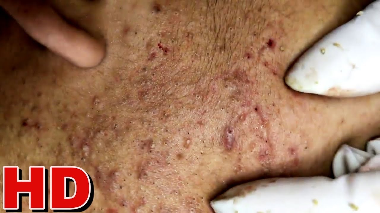HD EXTREME BLACKHEADS Extraction! 5 YouTube