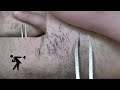 ひげの毛抜き⑩-2 Pull out the Beard.10-2 【tweezers】（5speeds）