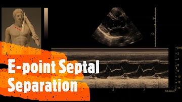 E-point Septal Separation (EPSS). Perioperative & Critical Care ECHO / POCUS
