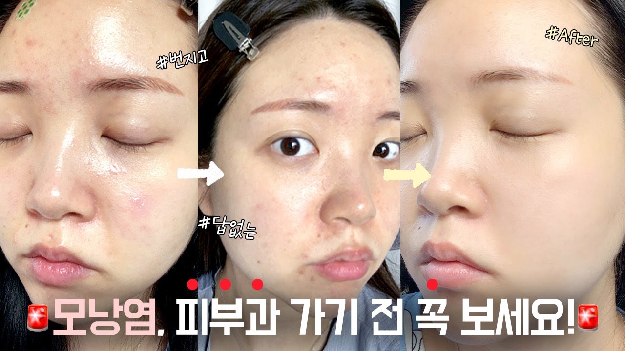 번지는 모낭염..🔥 피부과 NO! 모낭염 vs 여드름 구분법, 관리법 모두 공개합니다..! ㅣ HASOMY 하소미
