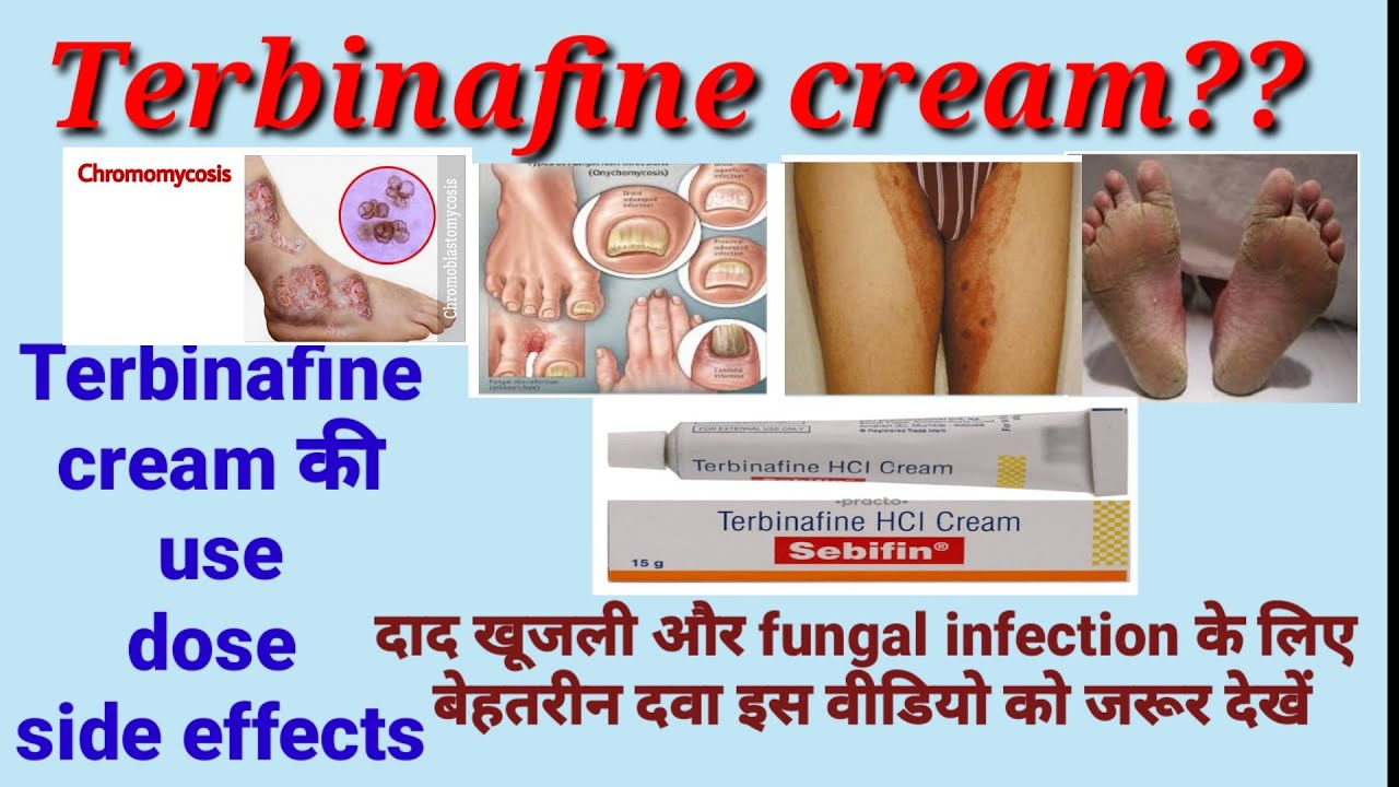 LAMISIL cream 1% terbinafine treatment fungal skin India | Ubuy