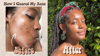 How I Cleared My Severe Adult Acne & Dark Marks At Home In A Few Months (Footage & Photos Included)