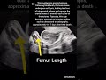 Pregnancy Ultrasound showing femur length! Obstetric Ultrasound!#ultrasoundmadeeasy86#viralshorts.