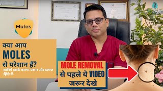 Best Mole Treatment | Laser or Surgery for Mole removal  in Delhi | Dr Jangid | SkinQure Clinic