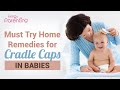 Simple and Effective Home Remedies for Cradle Caps in Babies