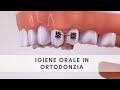 Come pulire i denti quando hai l’apparecchio ortodontico