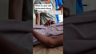 Boy with a dislocated elbow of 1 year.  #thatorthodoc #elbow #dislocation #chronic