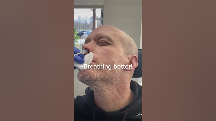 Another nasal splint removal after septoplasty and turbinate reduction
