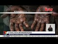 Martin Kimamo lives with hyperhidrosis, a condition entailing excessive sweating