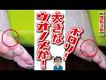 小指の大きなウオノメ除去！長年の痛みがスッキリ【相模原・町田巻き爪矯正センター】