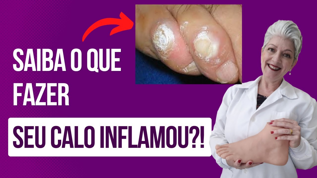CALO INFLAMADO Saiba o que fazer - YouTube