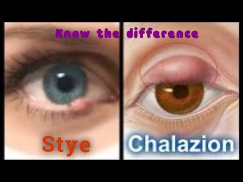 Video: Perbezaan Antara Chalazion Dan Stye