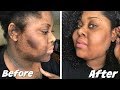 HOW TO GET RID OF STRETCH MARKS & SCARS FAST!  # ...