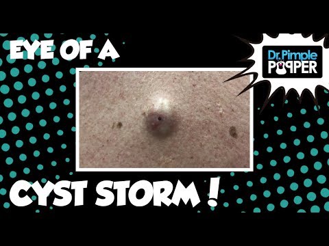 Eye of a Cyst Storm