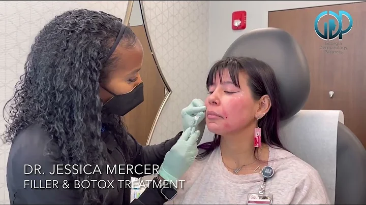 Filler & Botox treatment by Dr. Jessica Mercer