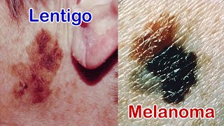 Old Age Spots (Lentigo) + Malignant Melanoma (Part 1 &amp; 2): One Is Common and One Is Deadly!
