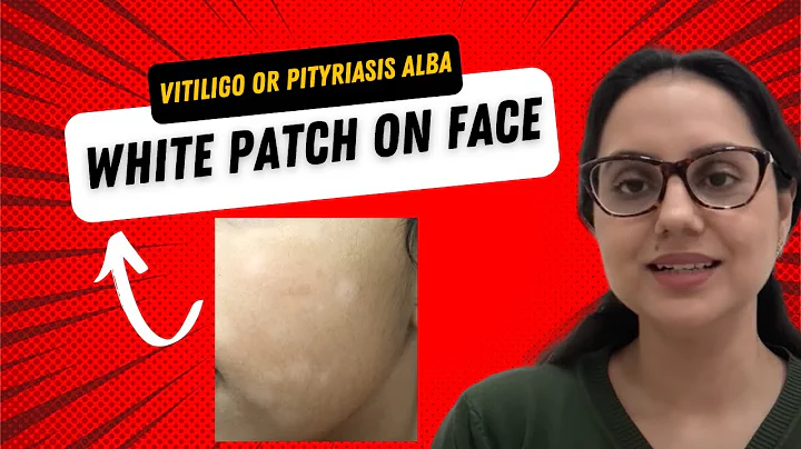 White patch on face- Is this Vitiligo or Pityriasis alba? II Dr Surbhi, MD - DayDayNews