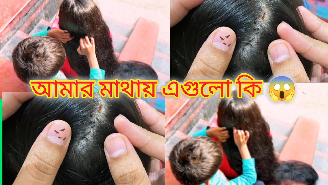Long Hair Nitpicking New Video||উকুন মারার ভিডিও||Lata's world || 