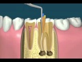 Traitement endodontiquedevitalisationflv