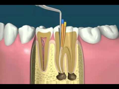 “Traitement endodontique= Traitement de racine”的图片搜索结果