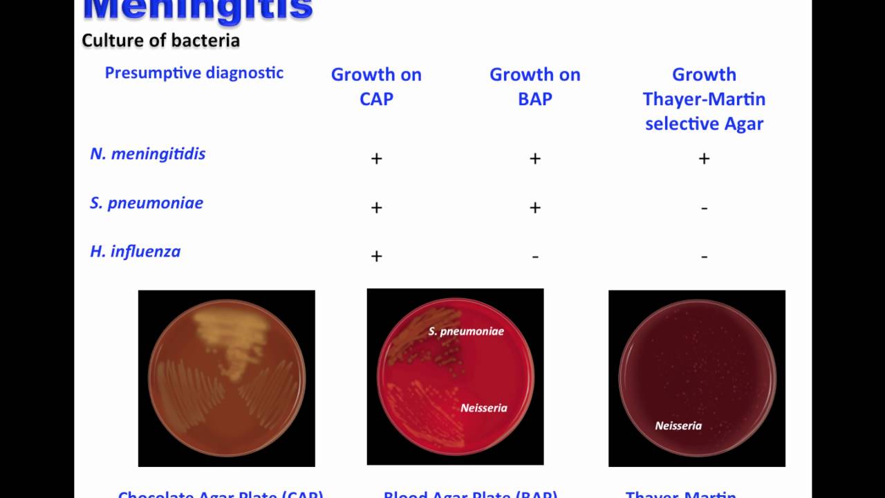 Meningococcal infection: Complement deficiency associated to Meningococcal infection Meningococcal infection: Complement deficiency associated to Meningococcal infection