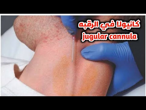 تعلم تركيب الكانيولا في الرقبه    