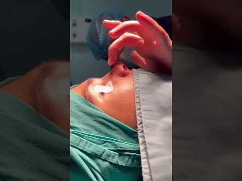 სეპტორინოპლასტიკა, septorhinoplasty,  Септоринопластика -გუგა კუზანოვი