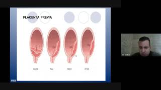 #Gynéco | 16. Le placenta prævia (PP) -Tizi- (Dr Galleze) screenshot 4