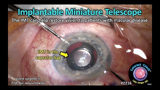 CataractCoach™ 2216: implantable mini telescope IMT for macular degeneration