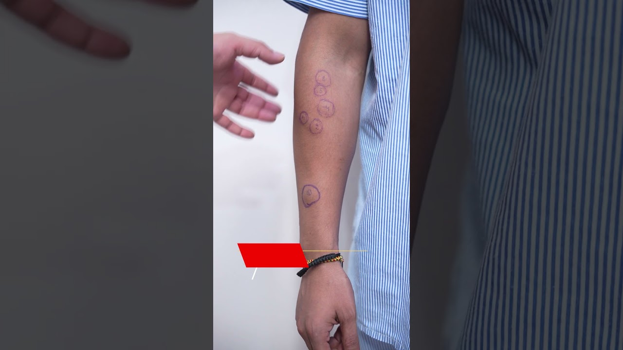 Lipoma Removal | Lipoma | Lipoma cost #Lipoma #short #Short #Shortvideo