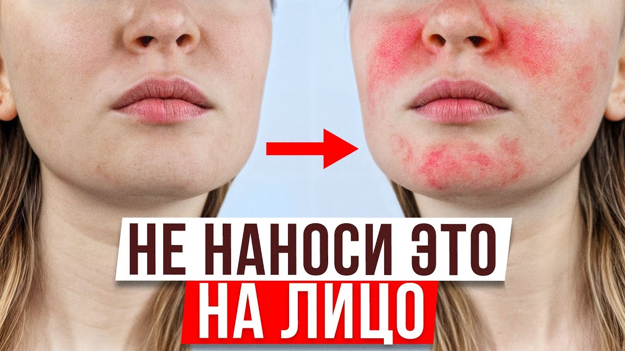 СПАСИ СВОЮ КОЖУ! Как побороть зависимость от гормональных мазей БЕЗ ПОСЛЕДСТВИЙ?