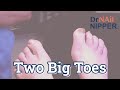 Throwback - Two Big Thick Toenails.  What are Fungal Toenails?