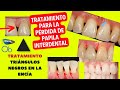 Tratamiento para la pérdida de Papila interdental 🦷 ▲ TRIÁNGULOS NEGROS EN LA ENCÍA