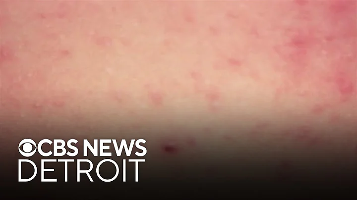 More measles cases reported across the United States