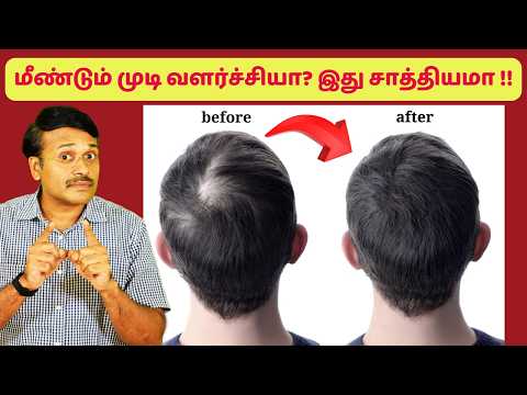 மீண்டும் முடி வளர்ச்சி இந்த 3 முறைகள் மூலம் நடக்குமா ? hair loss treatment