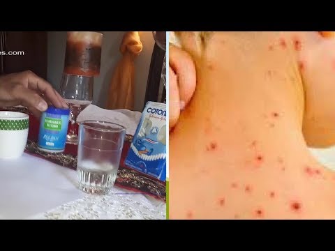 Vídeo: Cómo Aliviar La Picazón Con Varicela En Un Niño: Los Mejores Remedios, Consejos