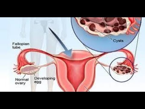 polycystic ovarian   disese  ovary cyst treatment by homeopathic or home remedies
