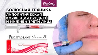 Липолитическая коррекция средней и нижней трети лица - техника иглы. Prostrolane Inner-B