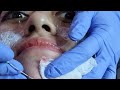 Treatment Perbaiki Bopeng Acne Scar | Pengalaman di Klinik Surabaya NO ENDORSE