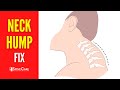 How to Fix Your Neck Hump | STEP-BY-STEP Guide