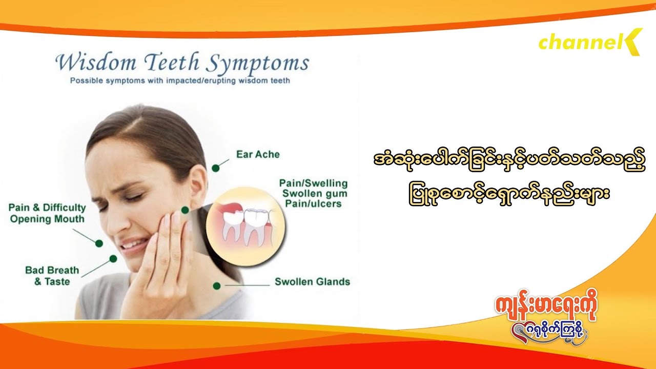 ကျန်းမာရေးကိုဂရုစိုက်ကြစို့ - အပိုင်း (၃၃) - အံဆုံးပေါက်ခြင်း