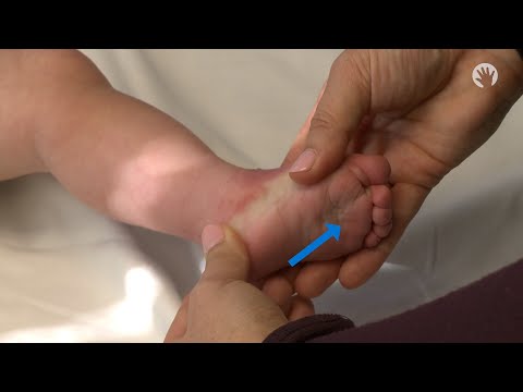 Videó: Clubfoot A kölykökben