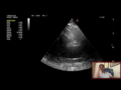 Video: A quali dimensioni dovrebbe essere riparato un aneurisma aortico ascendente?