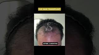 FUE Hair Transplant | 3,000 Grafts | 5-Month Results